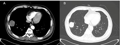 Anlotinib Combined With Chemotherapy for Recurrence of Pulmonary Sarcomatoid Cancer Previously Surgically Treated: A Case Report and Literature Review